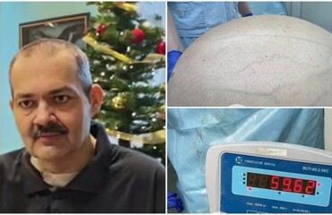 Мужчине удалили опухоль весом более 60 килограммов