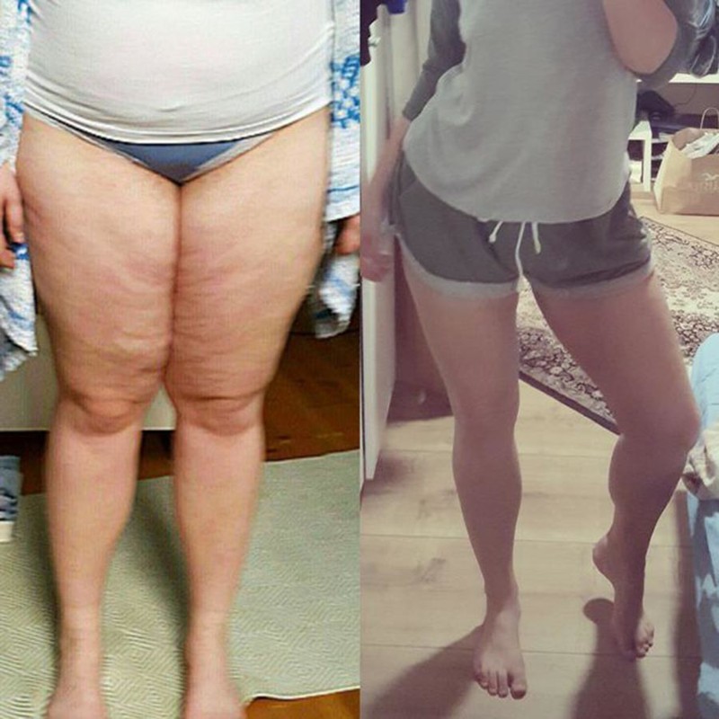 До 80 после 60. Ноги до и после похудения. Похудение на 50 кг. Ноги после похудения до и после. Похудение с 70 до 50.
